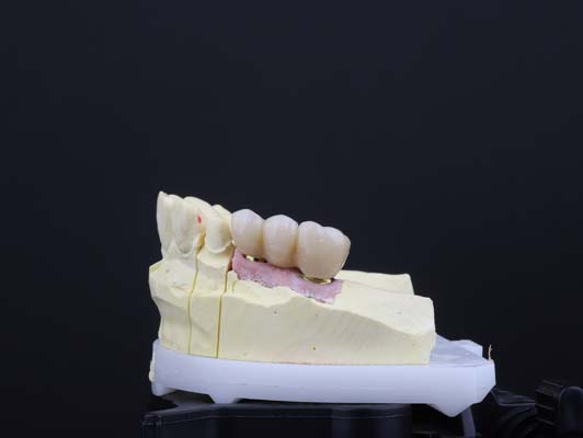 What Is A Porcelain Fixed Bridge?