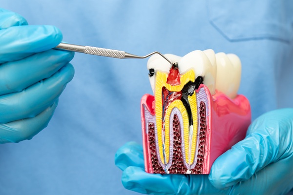 How Long Does It Take To Recover From A Root Canal?